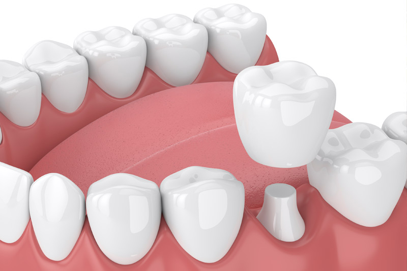 Dental Crowns in Robbinsdale