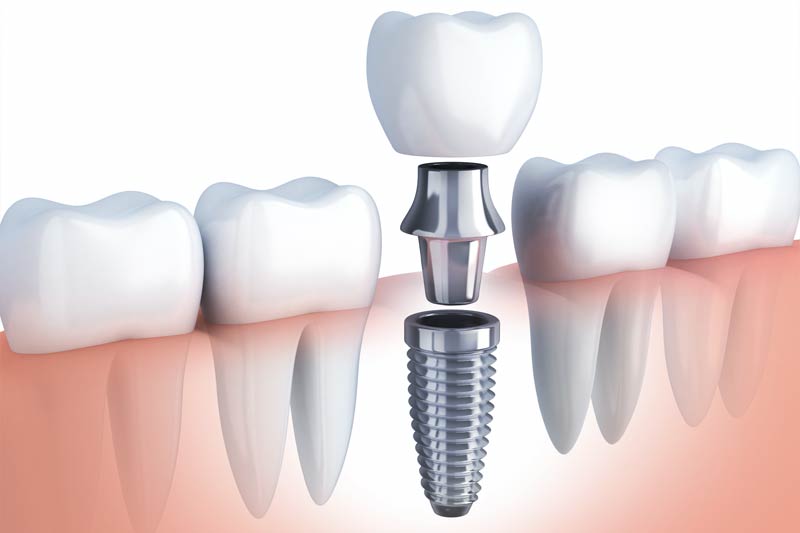 Implants Dentist in Robbinsdale