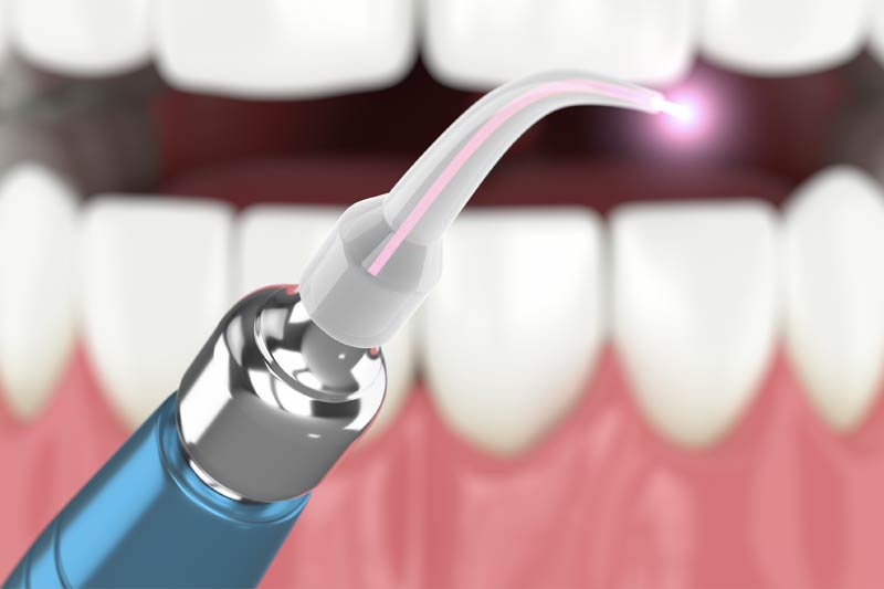 Laser Dentistry in Robbinsdale