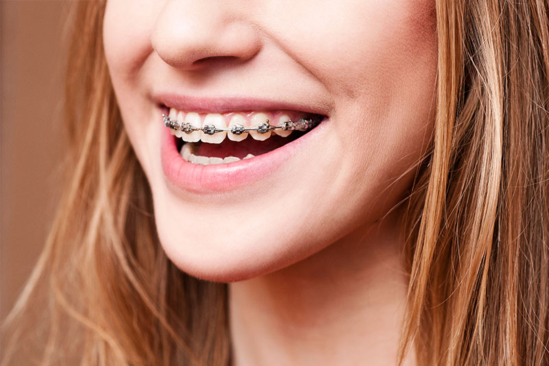 Orthodontics in Robbinsdale