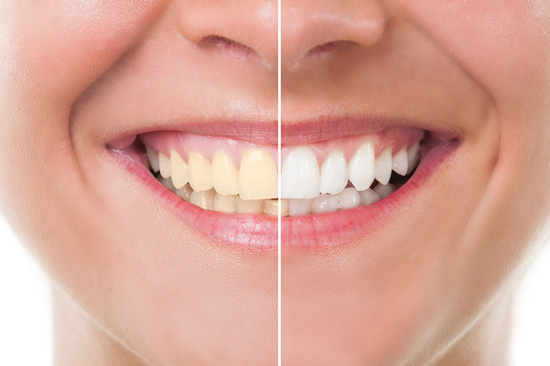 Teeth Whitening in Robbinsdale