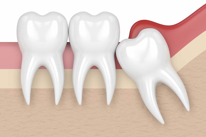 Wisdom Tooth Removal in Robbinsdale